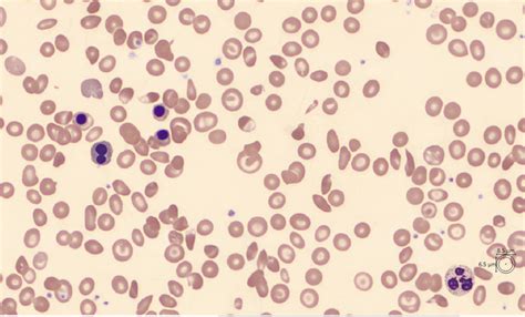 hemoglobin s beta thalassemia|The compound state: Hb S/beta.
